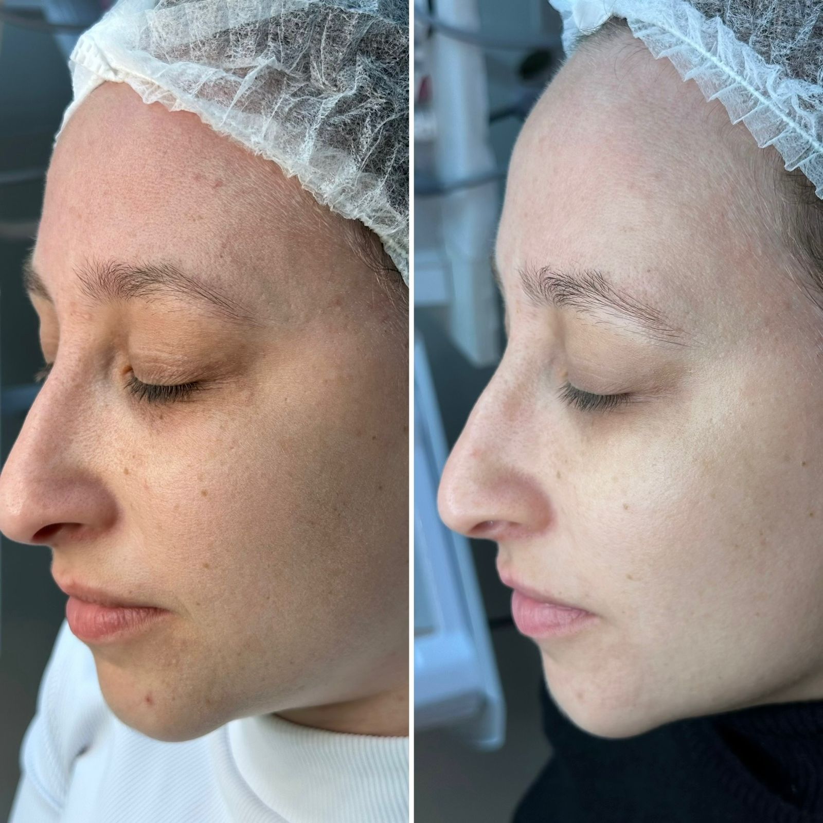 Aline Dieter Curso Skin Peach