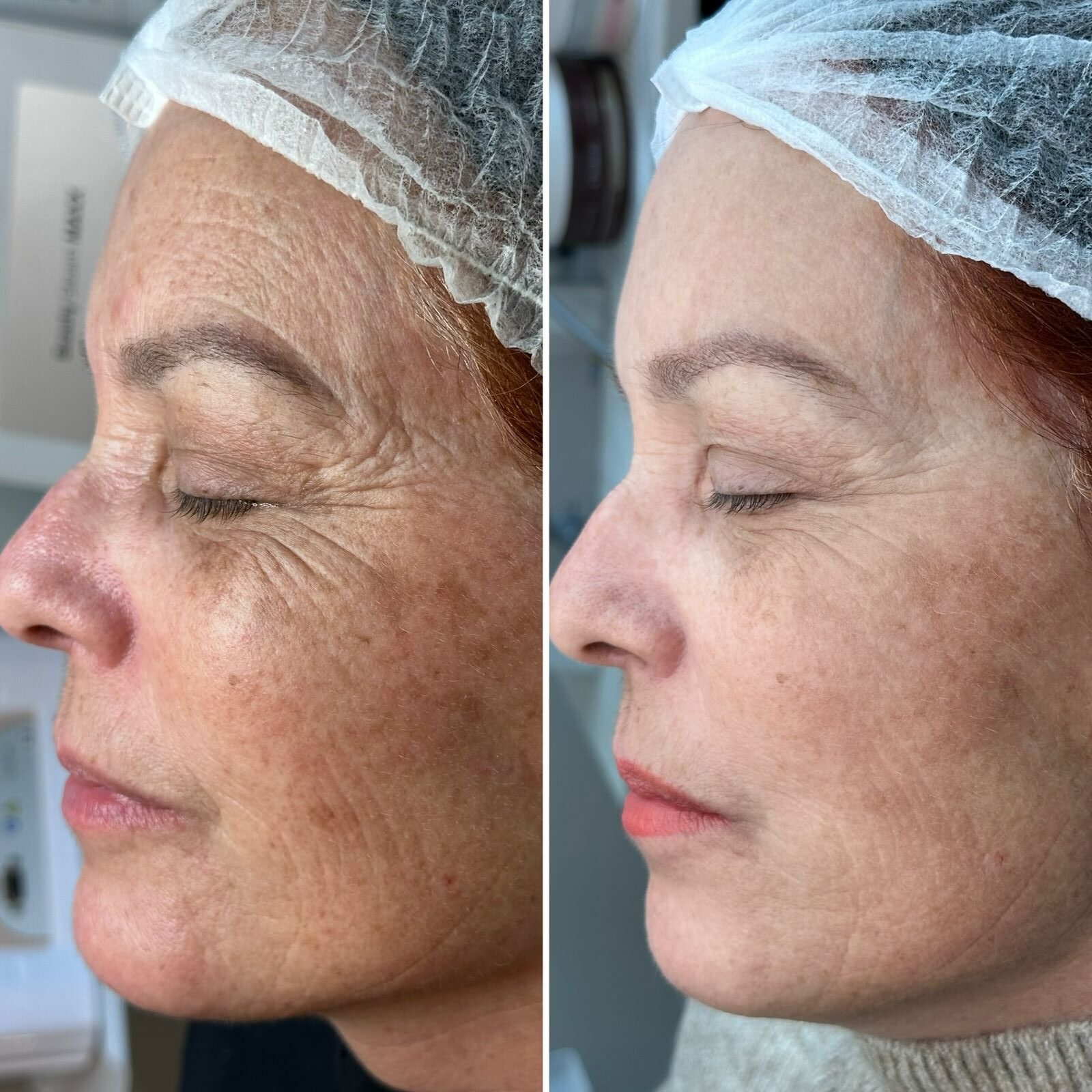 Aline Dieter Curso Skin Peach