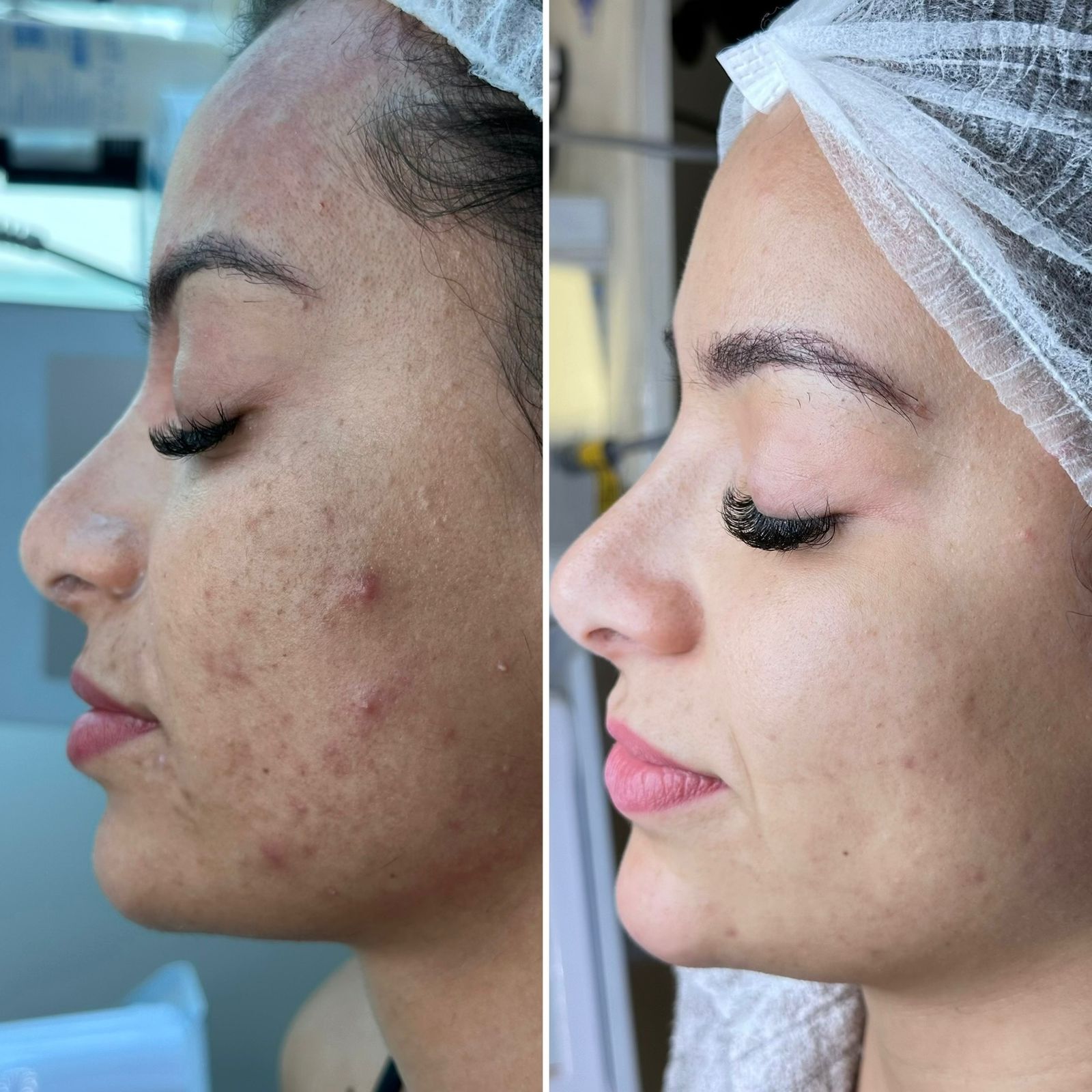 Aline Dieter Curso Skin Peach