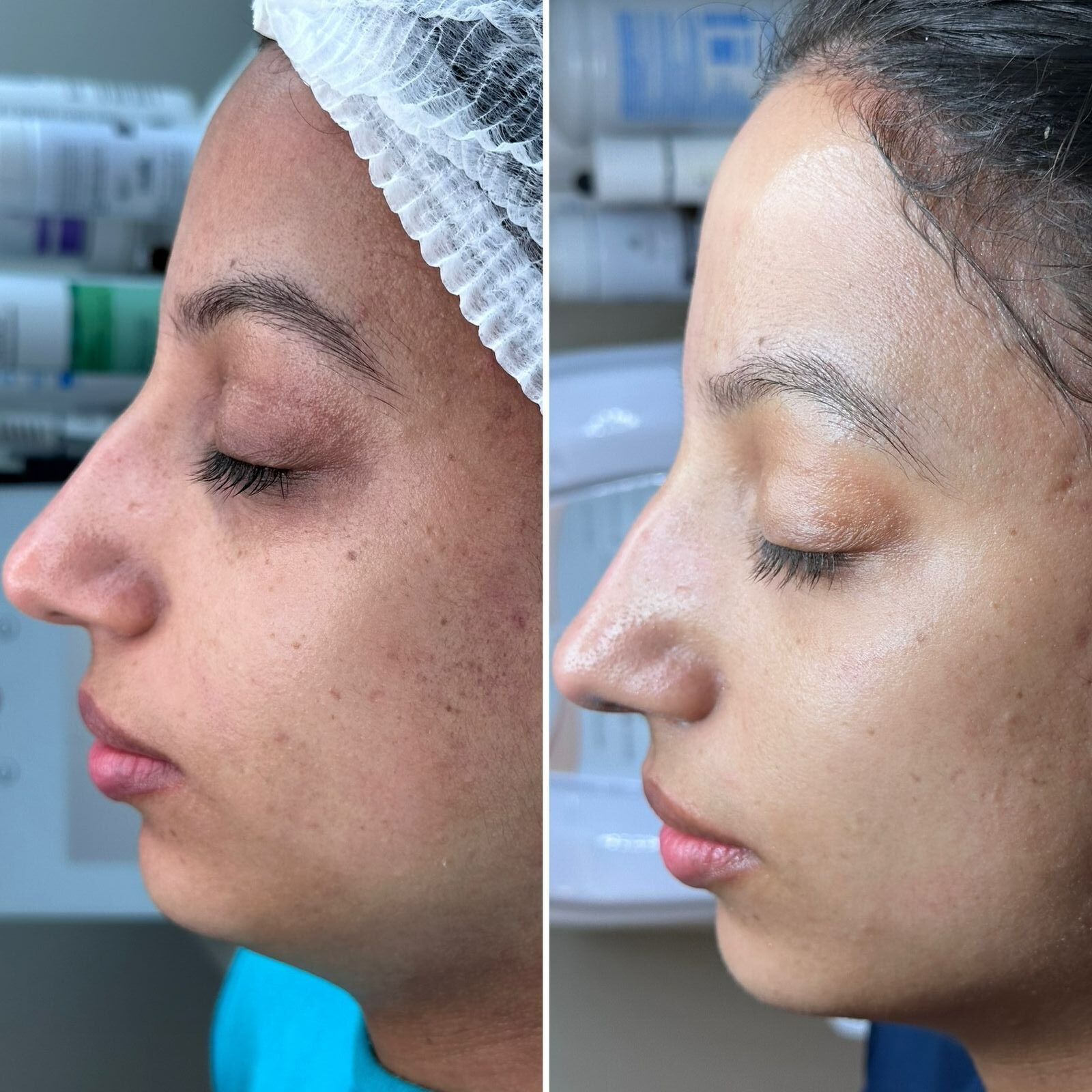 Aline Dieter Curso Skin Peach
