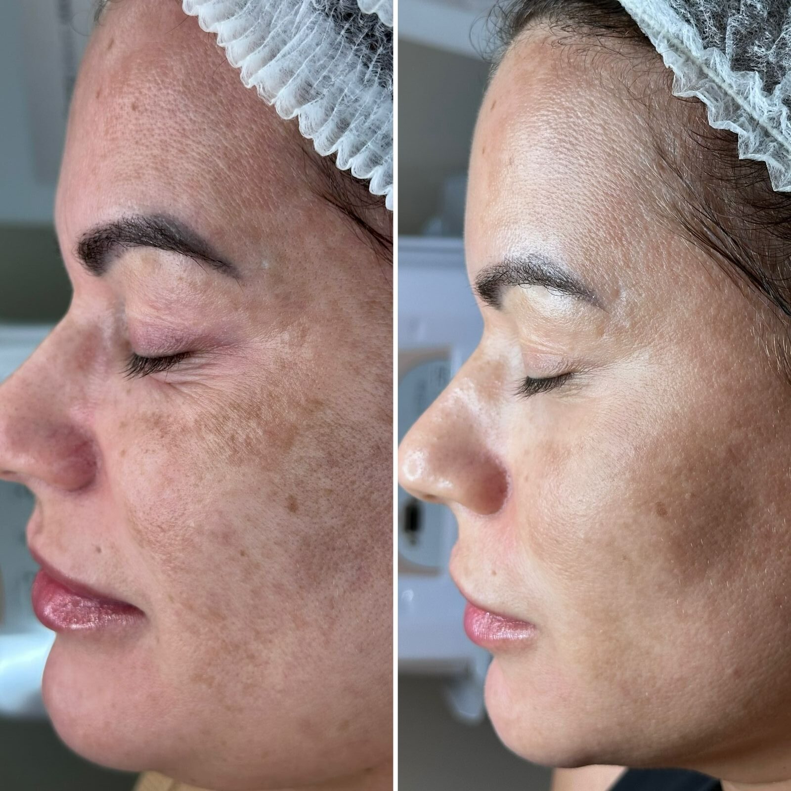 Aline Dieter Curso Skin Peach